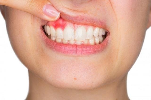 Sưng nướu răng có thể do nhiều nguyên nhân gây ra